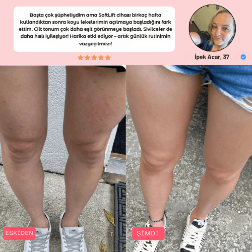 SoftLift – Selülit Karşıtı Masaj Aleti