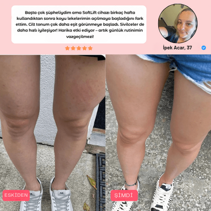 SoftLift – Selülit Karşıtı Masaj Aleti