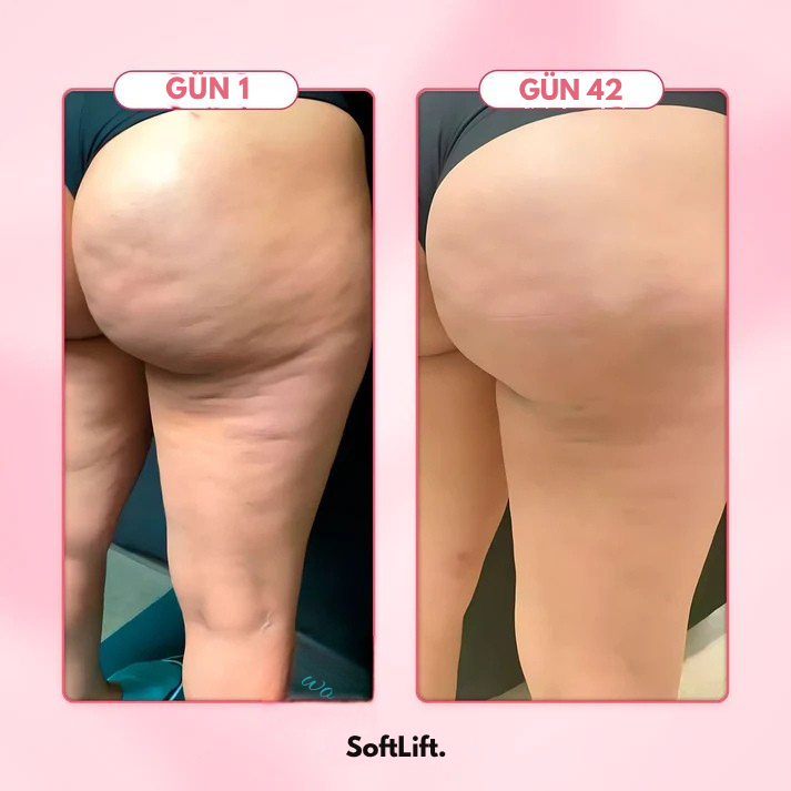 SoftLift – Selülit Karşıtı Masaj Aleti