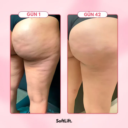 SoftLift – Selülit Karşıtı Masaj Aleti