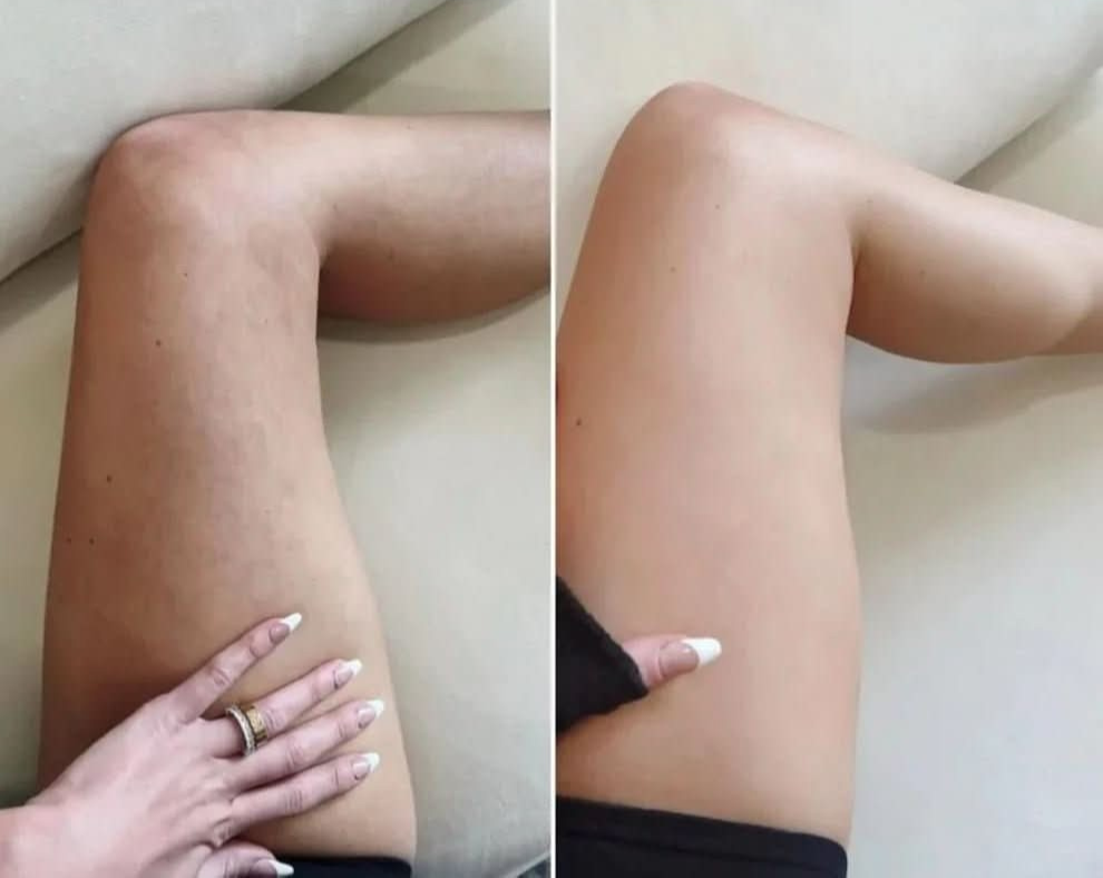 SoftLift – Selülit Karşıtı Masaj Aleti